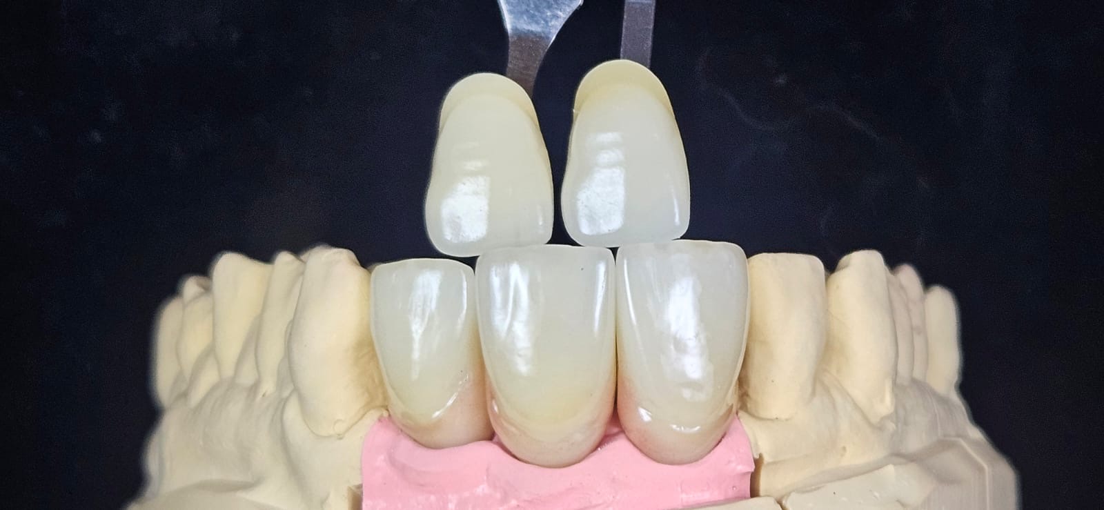 Keramische Restaurationen